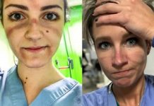 Лікарі показали, як виглядають їхні обличчя після доби роботи в умовах пандемії коронавіруса